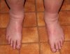 Martins-swollen-feet.jpg